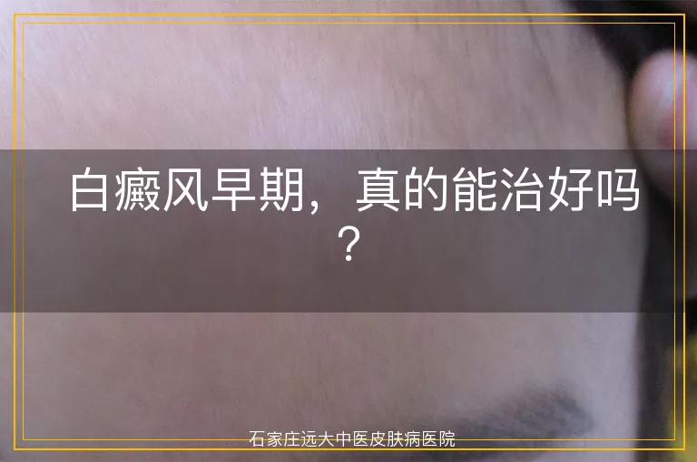 白癜风早期，真的能治好吗？