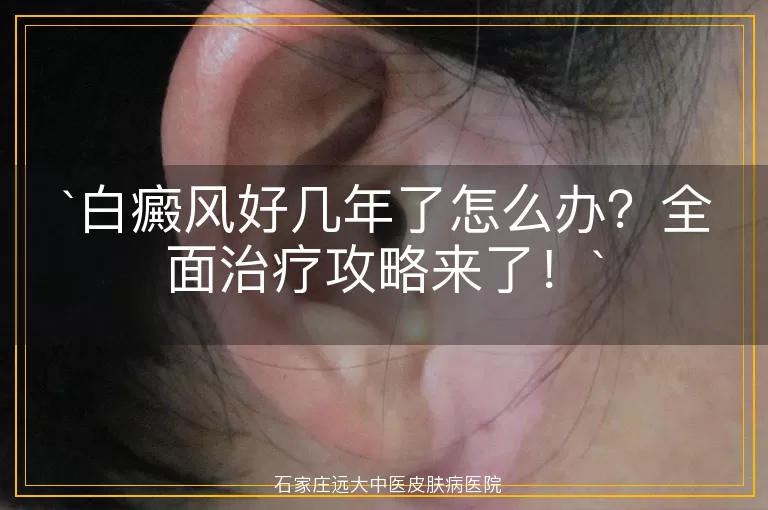 白癜风好几年了怎么办？全面治疗攻略来了！
