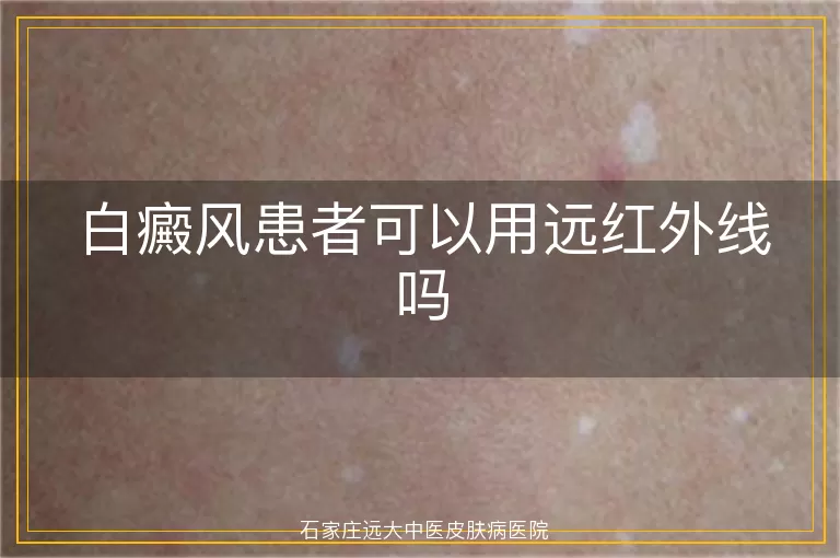 白癜风患者可以用远红外线吗