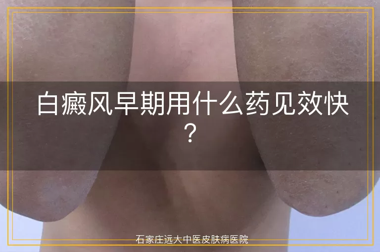 白癜风早期用什么药见效快？