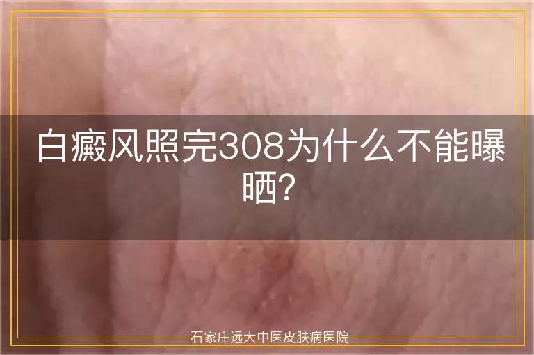 白癜风照完308为什么不能曝晒？