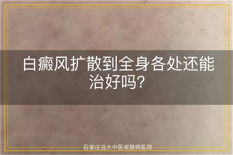 白癜风扩散到全身各处还能治好吗？