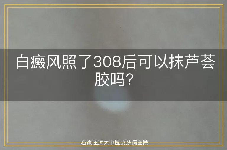 白癜风照了308后可以抹芦荟胶吗？