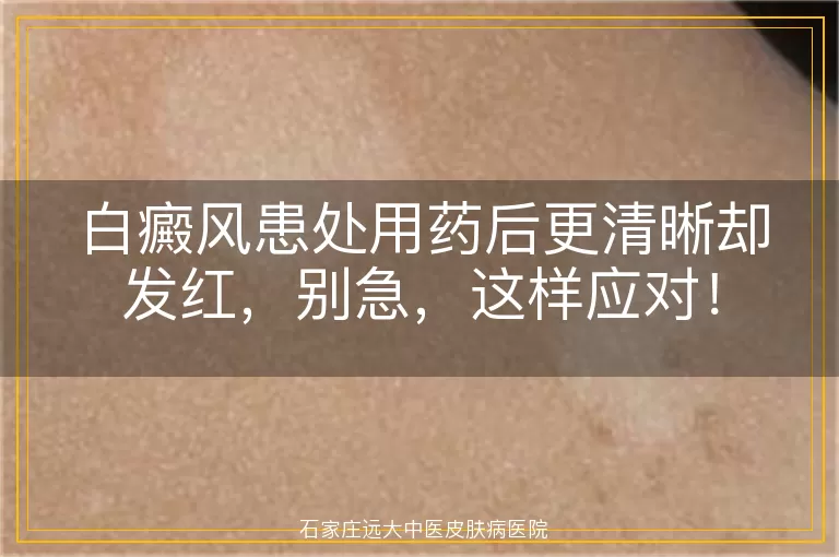 白癜风患处用药后更清晰却发红，别急，这样应对！