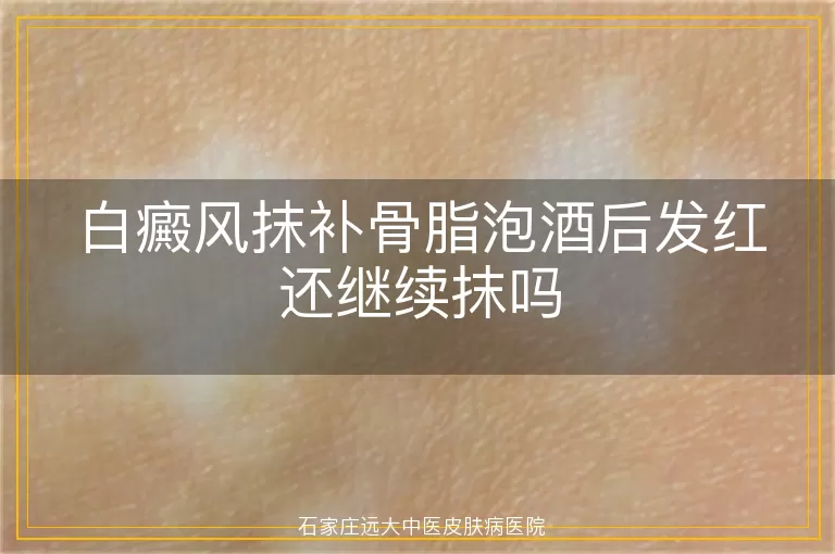 白癜风抹补骨脂泡酒后发红还继续抹吗