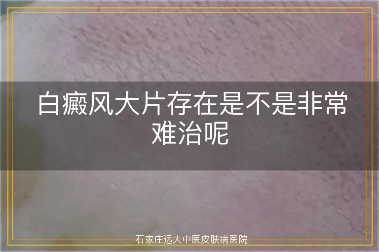 白癜风大片存在是不是非常难治呢