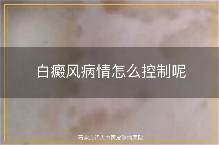 白癜风病情怎么控制呢