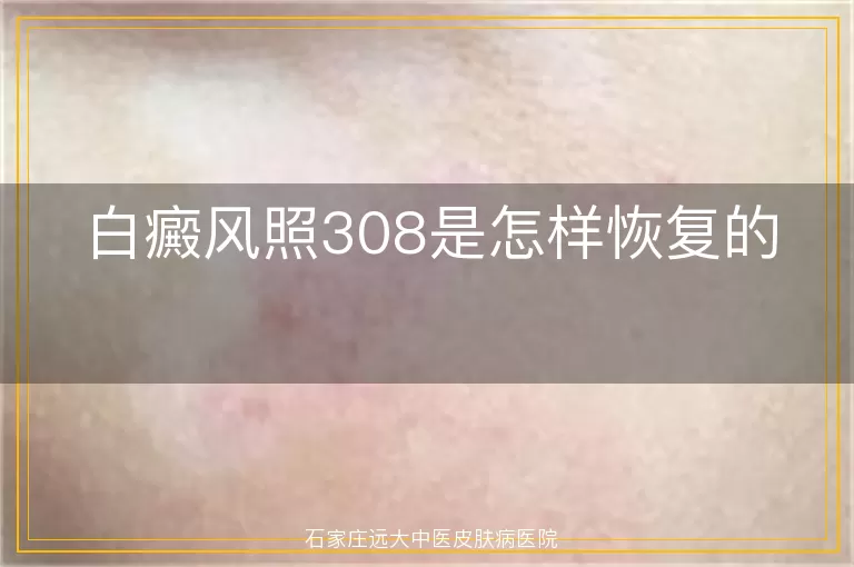 白癜风照308是怎样恢复的