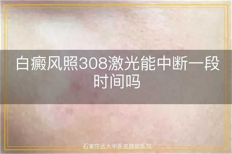 白癜风照308激光能中断一段时间吗