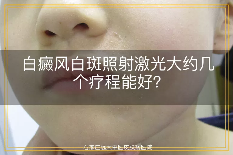 白癜风白斑照射激光大约几个疗程能好?
