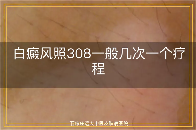 白癜风照308一般几次一个疗程