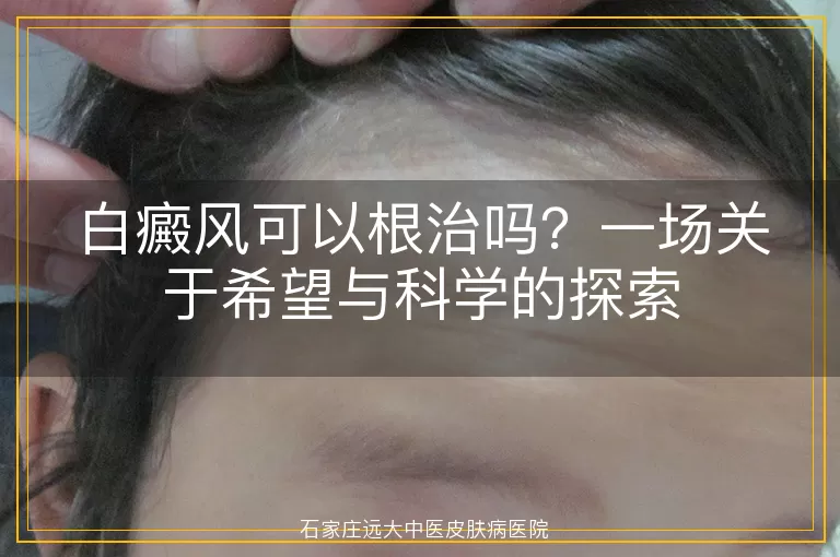 白癜风可以根治吗？一场关于希望与科学的探索