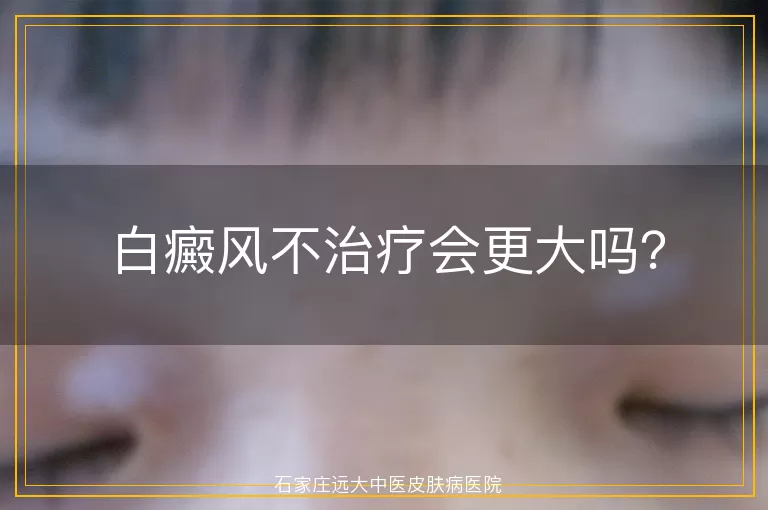 白癜风不治疗会更大吗？