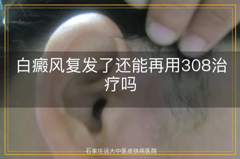 白癜风复发了还能再用308治疗吗
