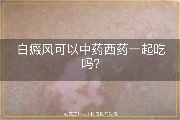 白癜风可以中药西药一起吃吗？