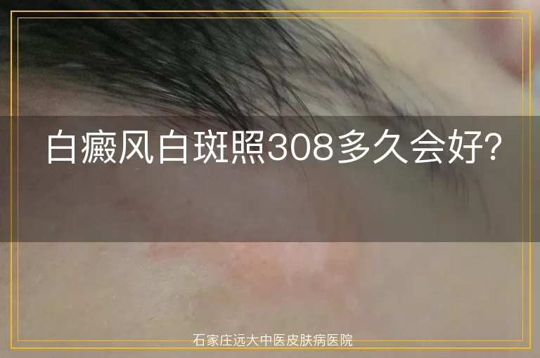 白癜风白斑照308多久会好？