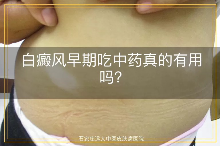 白癜风早期吃中药真的有用吗？