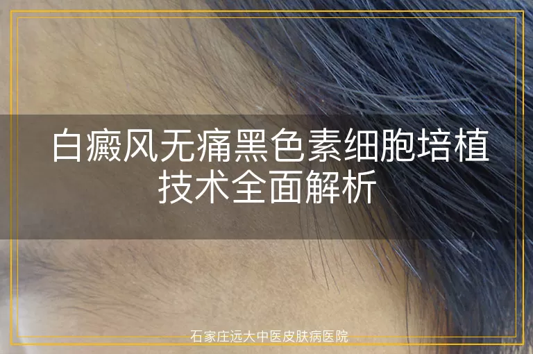 白癜风无痛黑色素细胞培植技术全面解析
