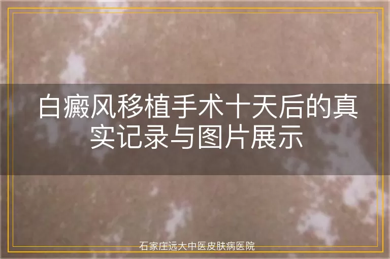 白癜风移植手术十天后的真实记录与图片展示