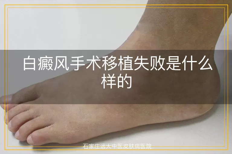 白癜风手术移植失败是什么样的