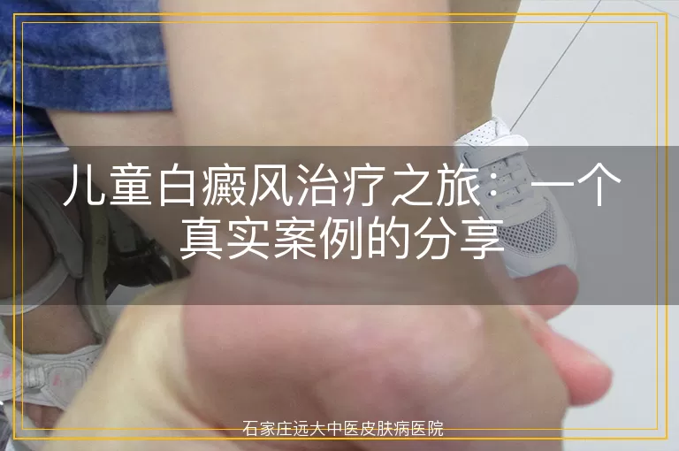 儿童白癜风治疗之旅：一个真实案例的分享
