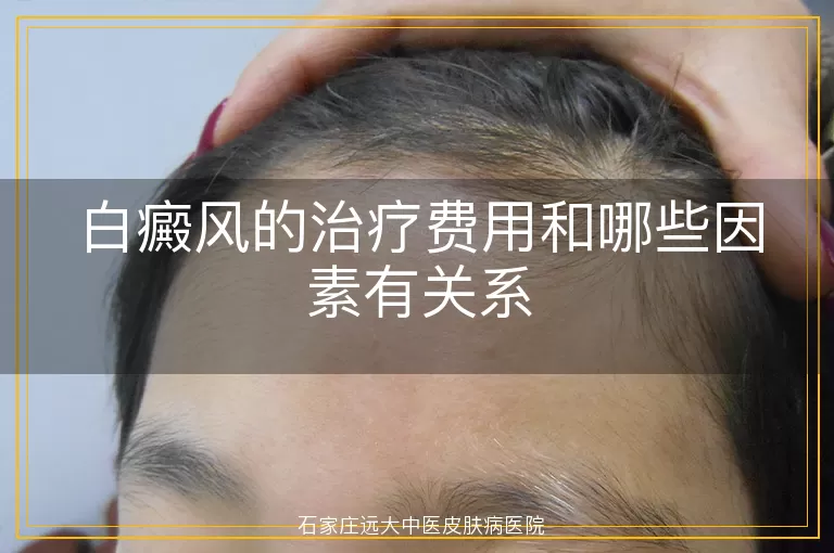 白癜风的治疗费用和哪些因素有关系