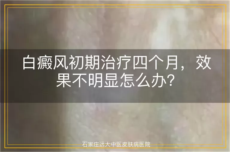 白癜风初期治疗四个月，效果不明显怎么办？