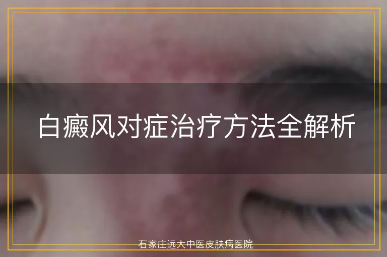 白癜风对症治疗方法全解析