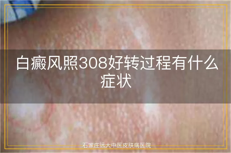 白癜风照308好转过程有什么症状