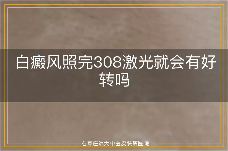 白癜风照完308激光就会有好转吗
