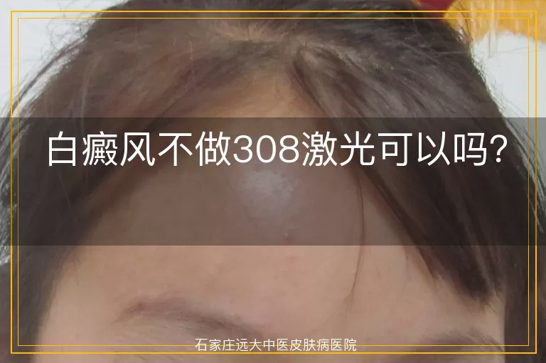 白癜风不做308激光可以吗？