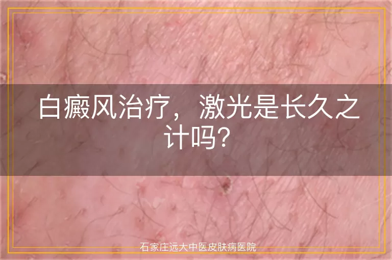 白癜风治疗，激光是长久之计吗？