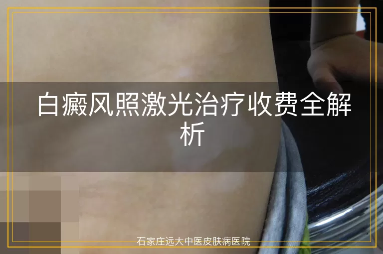 白癜风照激光治疗收费全解析