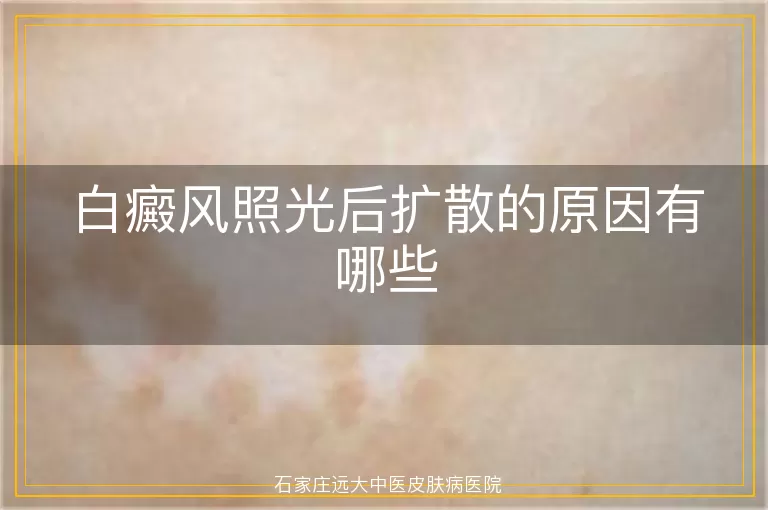白癜风照光后扩散的原因有哪些