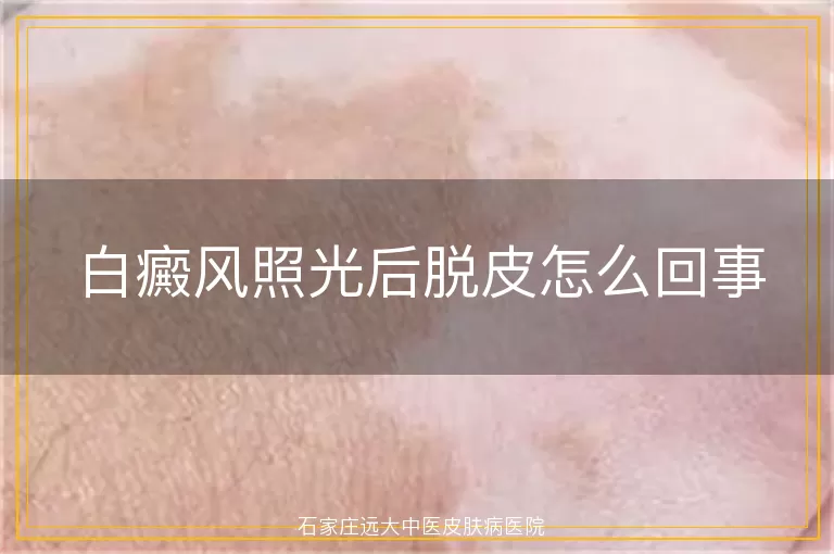 白癜风照光后脱皮怎么回事