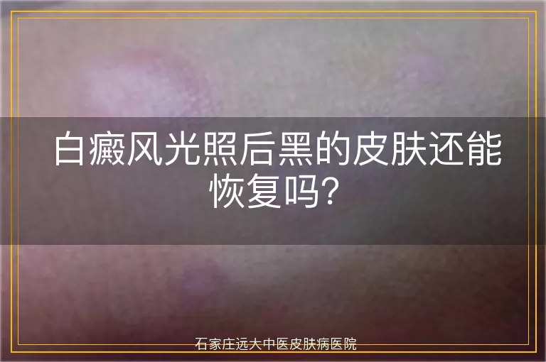 白癜风光照后黑的皮肤还能恢复吗？
