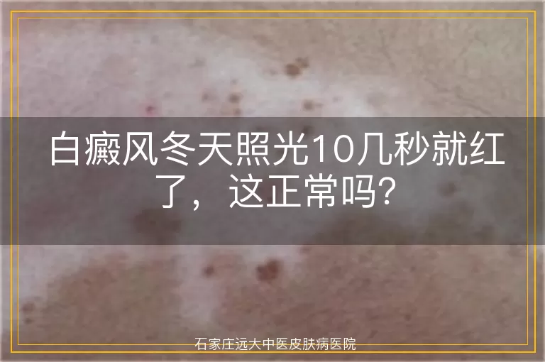 白癜风冬天照光10几秒就红了，这正常吗？