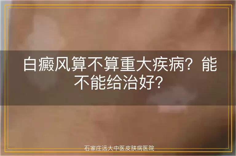 白癜风算不算重大疾病?能不能给治好?