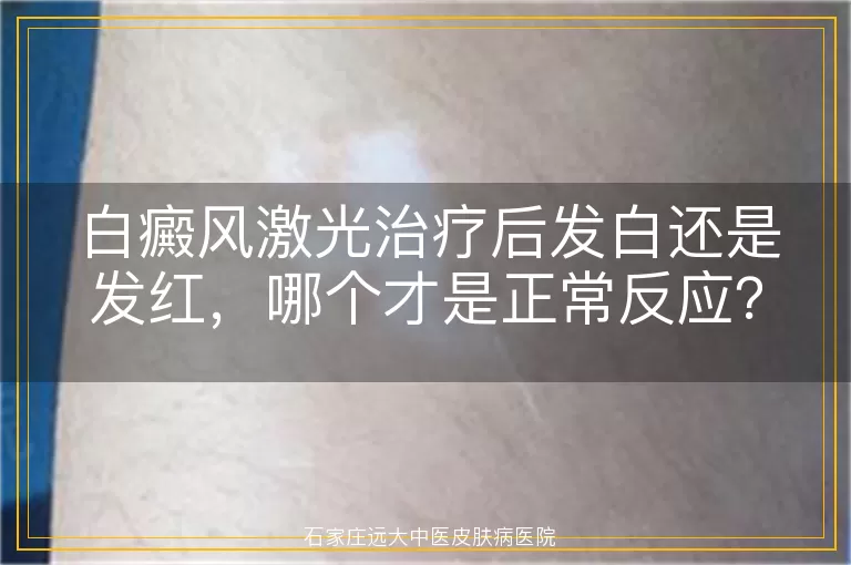 白癜风激光治疗后发白还是发红，哪个才是正常反应？