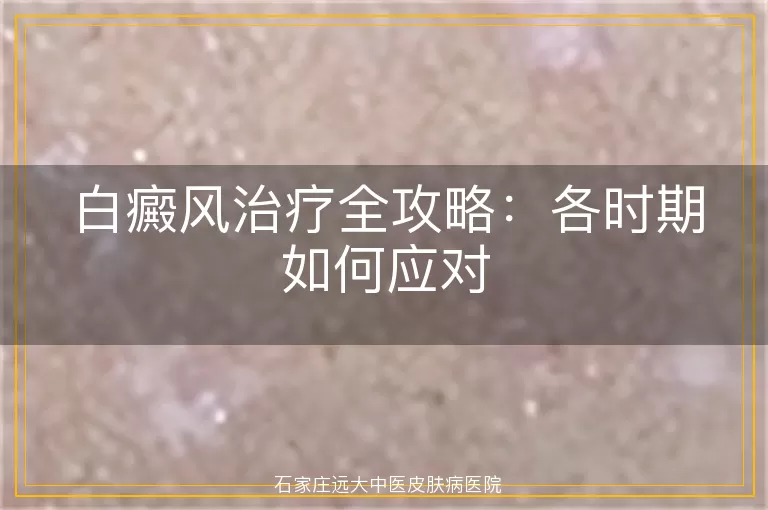 白癜风治疗全攻略：各时期如何应对