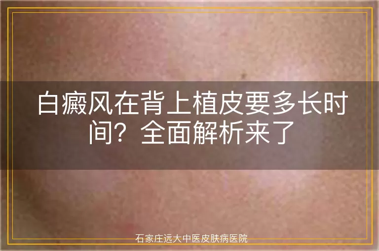 白癜风在背上植皮要多长时间？全面解析来了