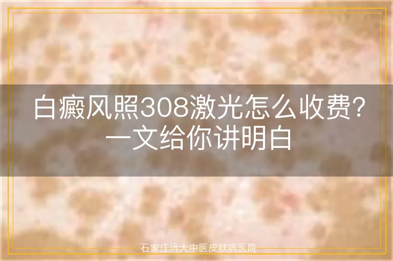 白癜风照308激光怎么收费？一文给你讲明白