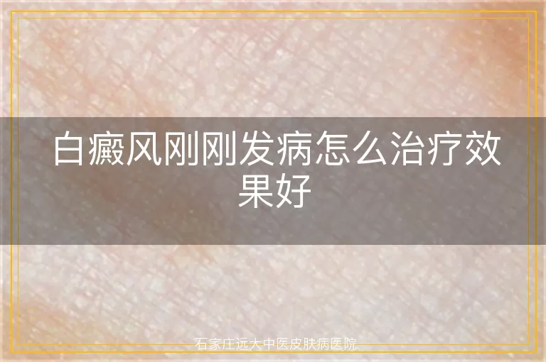 白癜风刚刚发病怎么治疗效果好