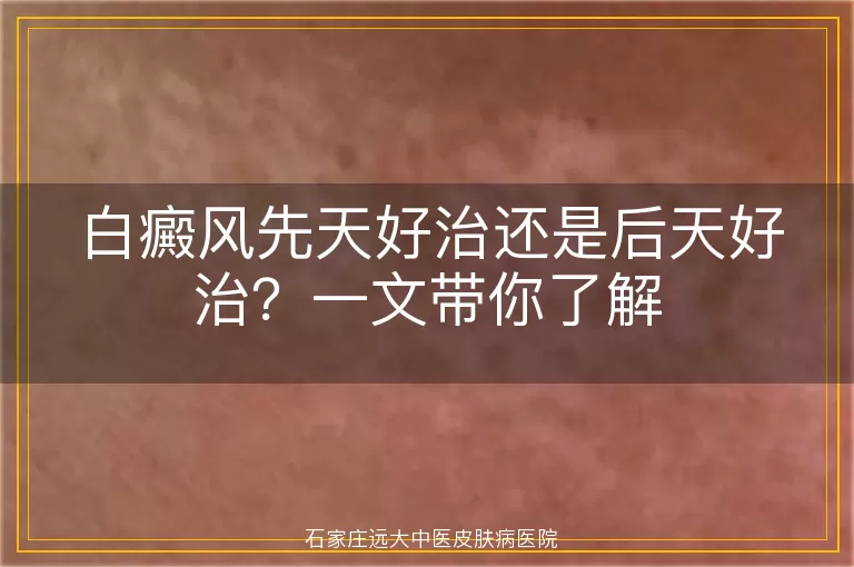 白癜风先天好治还是后天好治?一文带你了解