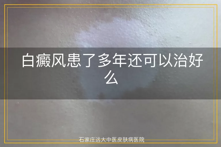 白癜风患了多年还可以治好么