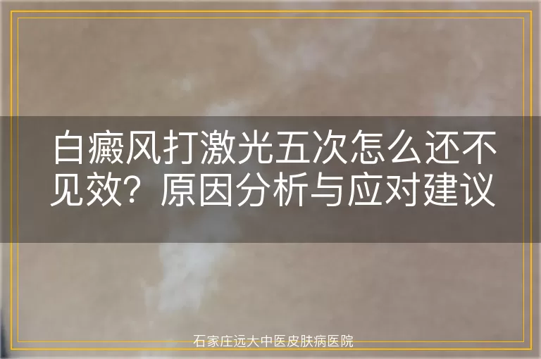 白癜风打激光五次怎么还不见效？原因分析与应对建议