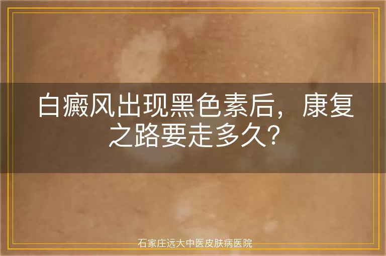 白癜风出现黑色素后，康复之路要走多久？