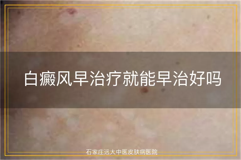 白癜风早治疗就能早治好吗