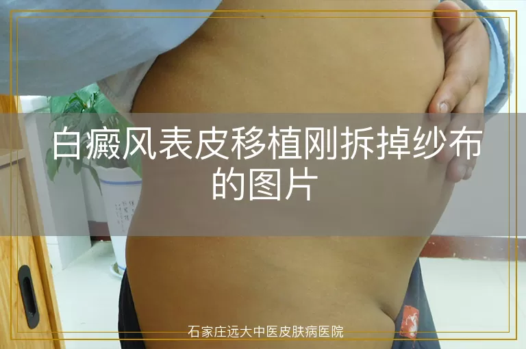 白癜风表皮移植刚拆掉纱布的图片