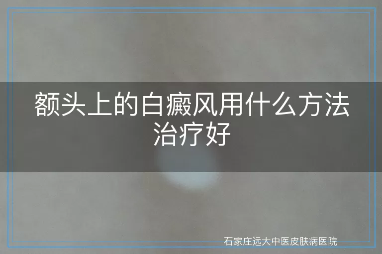 额头上的白癜风用什么方法治疗好
